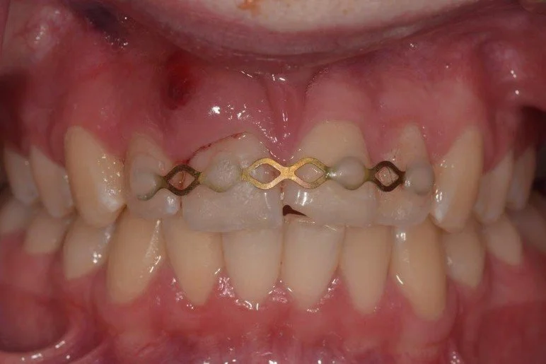 Endodontic Emergencies