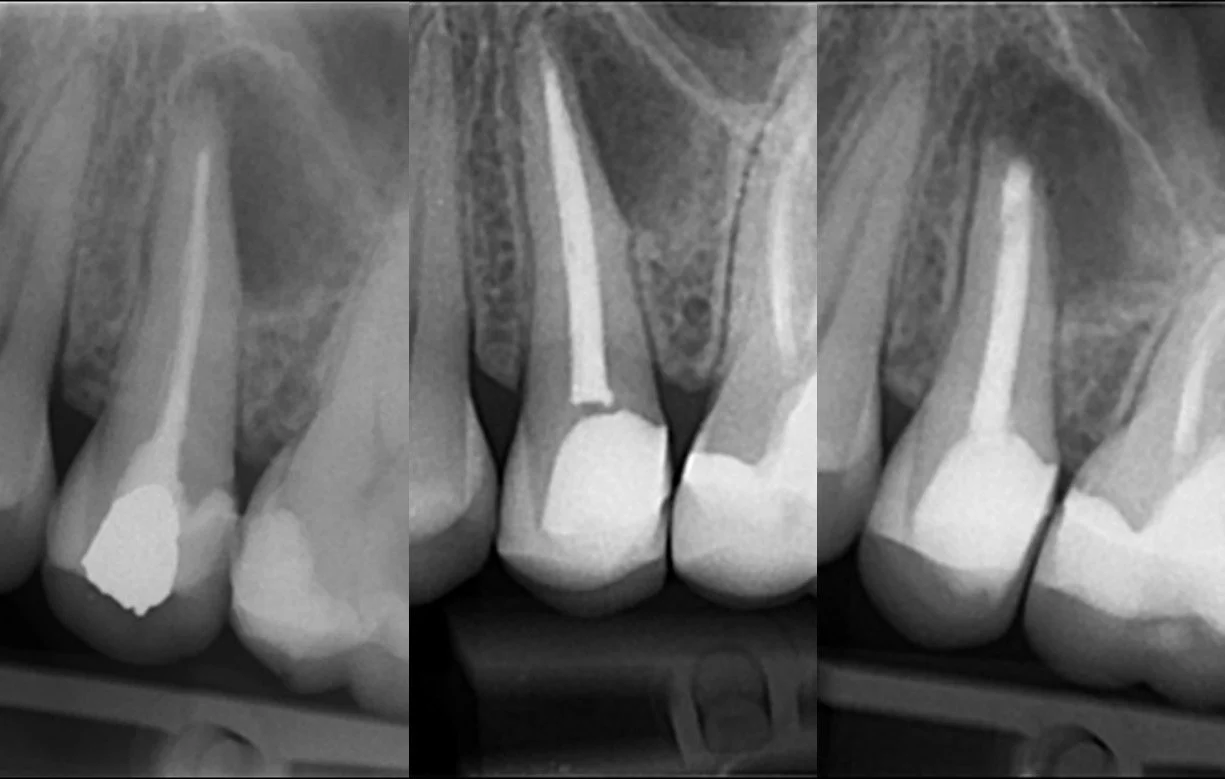 Endodontic Microsurgery