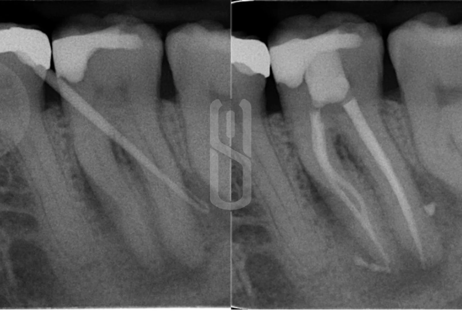Endodontic Treatment