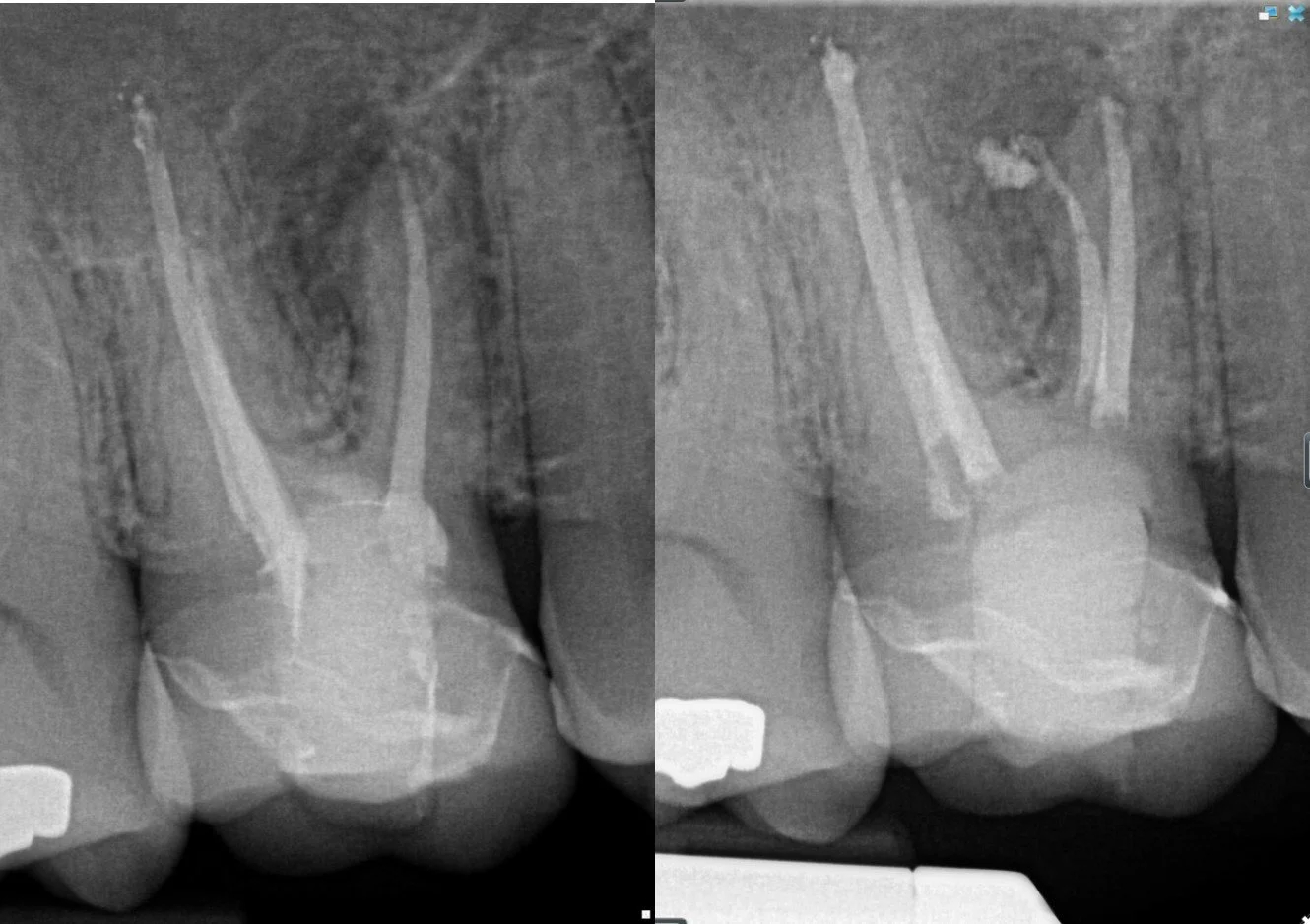 Endodontic Retreatment