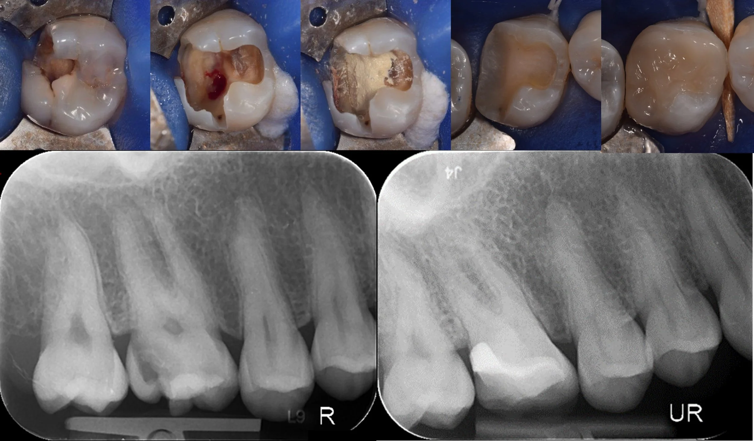 Preserving Pulp Vitality