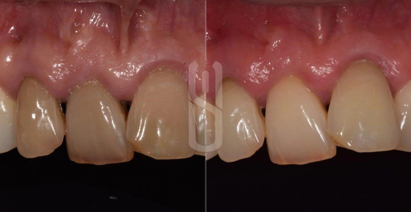 Whitening Discoloured Teeth